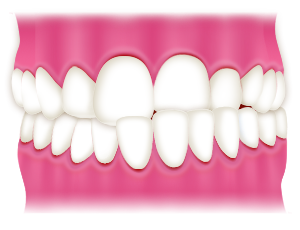 交叉咬合（下の歯列が上の歯列よりも前に出ている）