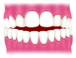 開咬（噛み合わせたときに上の前歯と下の前歯の間にすき間できる）